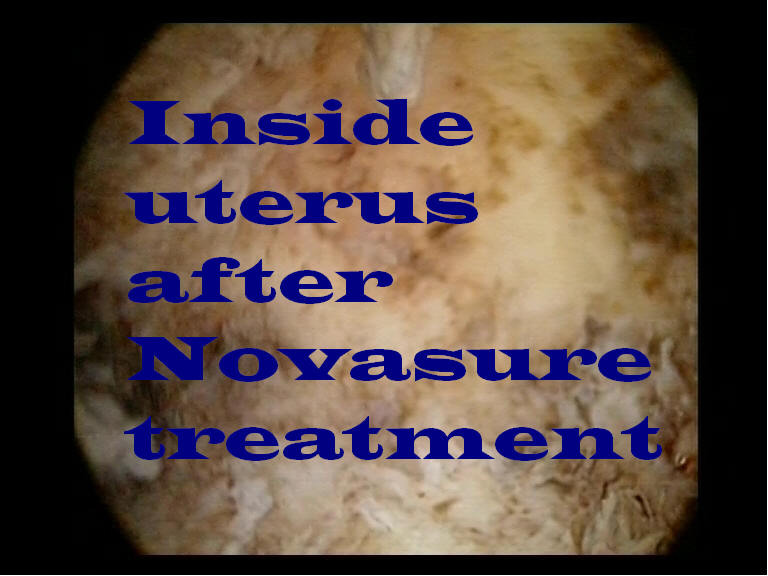 Novasure Effect on endometrium